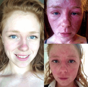 Alice cleared eczema