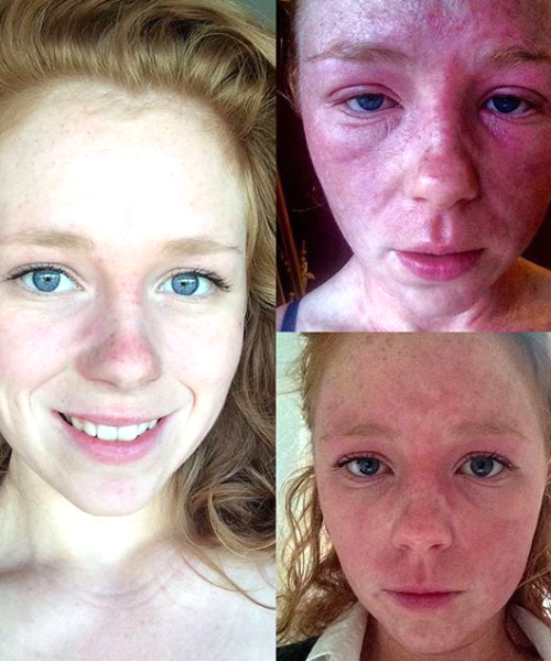 Detox Plus Diet Erases Eczema For British Woman Rebuilding My Health